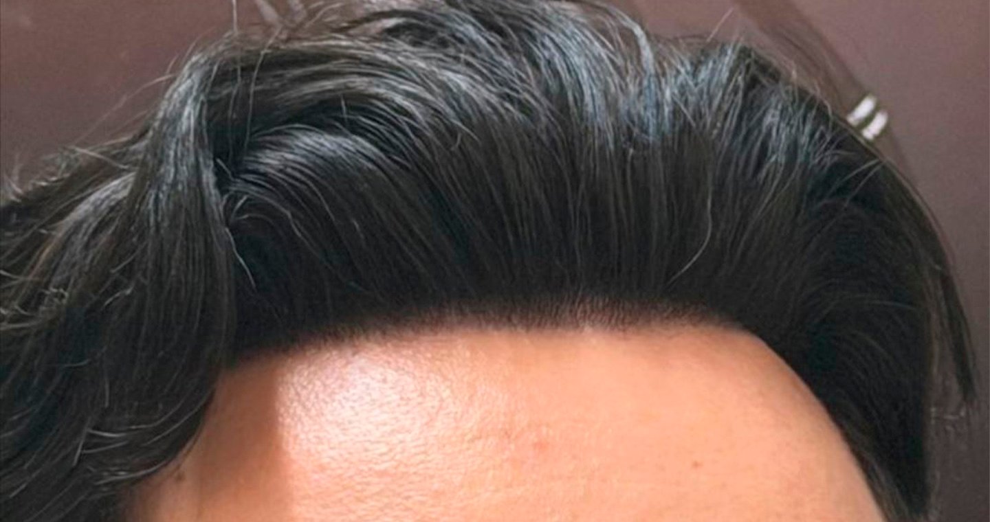 Detalhe da linha frontal de uma prótese capilar aplicada em Joinville, com acabamento natural