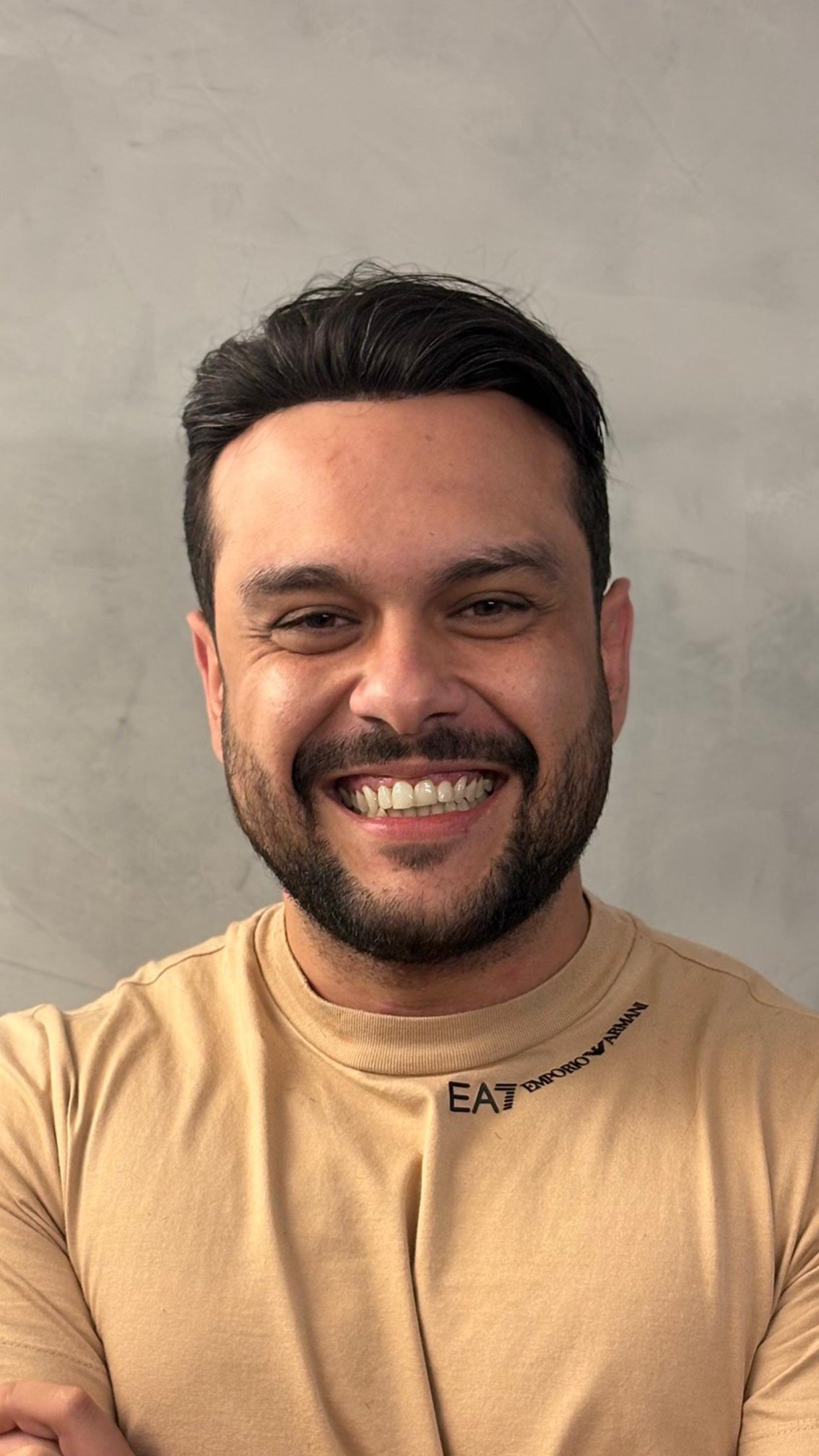 Depois da aplicação de prótese capilar masculina na Maicon Pacheco Barbearia